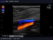 Ultrazvok ven 8 - Muralna tromboza vene poplitee