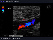 Ultrazvok arterij na nogi 4 -Blaga ateroskleroza arterije poplitee