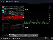 Ultrazvok arterij na nogi 3 -Znižane hitrosti v arteriji tibialis posterior