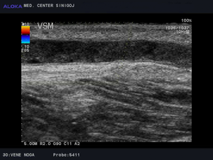 Ultrazvok žil nog - tromboza vene saphene magne