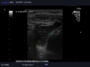 Ultrazvok rame - vnetje subkorakoidne burse  bursitis