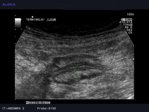 Ultrazvok prebavil - terminalni ileum 2