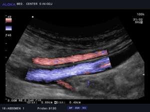 Ultrazvok žil trebuha - arterija in vena iliaka  normalen izvid