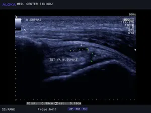 Ultrazvok rame - natrganje tetive m. supraspinatus