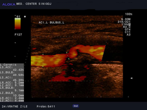 Photo of an ultrasound of the jugular veins.