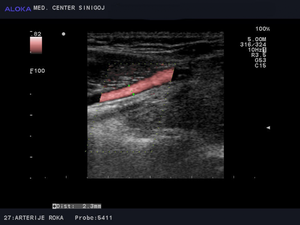 Ultrazvok žil rok - arterija radialis  normalen izvid