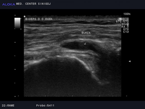 Ultrazvok rame - burzitis bicepsove burze  desna rama burza