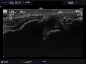 Ultrazvok kolena - kalcinacije v patelarnem ligamentu, indikacija za ESWT 2