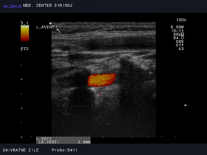 Ultrazvok vratnih žil - normalno široka leva vertebralna arterija