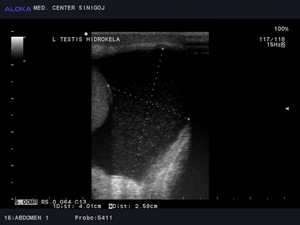 Ultrazvok testisov - hidrokela levega testisa 2