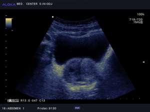 Ultrazvok prostate - benigna hipertrofija prostate 9