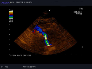 Ultrazvok možganskih žil - desna vertebralna arterija  normalen izvid