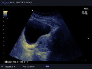 Prostate ultrasound photo