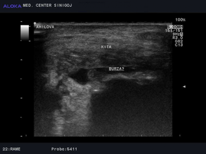 Ultrazvok Ahilove tetive - vnetje burze pod kito subtendinalni burzitis