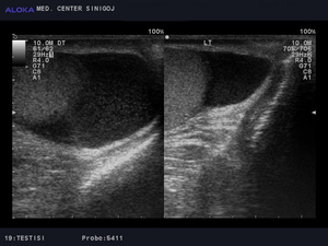 Ultrazvok testisov - obojestranska spermatokela (semenska tekočina ob testisu)
