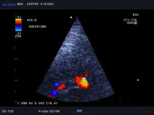 Ultrazvok možganskih žil - anevrizma na sprednji komunikantni arteriji (ACoA)