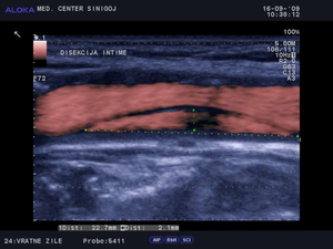 Ultrazvok vratnih žil - disekcija intime 2 3 x 0 2 cm  vzdolžno