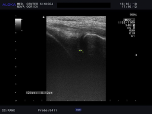 Ultrazvok kolena - možna poškodba meniska 2