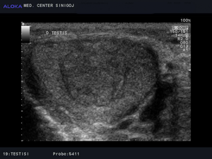 Ultrazvok testisov - tumor desnega testisa  najverjetneje seminom