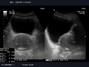 Ultrazvok prostate - benigna hipertrofija prostate 5