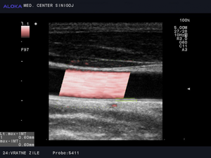 Photo of an ultrasound of the jugular veins.