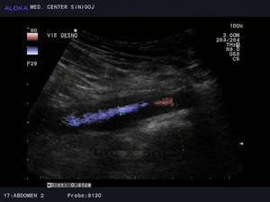 Ultrazvok žil trebuha - tromboza vene iliake eksterne