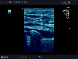 Ultrazvok rame - kalcinirajoči peritendinitis tetive bicepsa s tekočinskim plaščem  vzdolžno