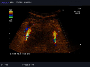 Ultrazvok možganskih žil - vertebralni arteriji  normalen izvid 2