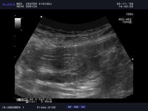 Ultrazvok prebavil - tanko črevo uvihano samo vase (intususcepcija) - vzdolžni presek