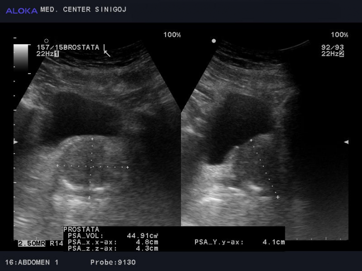 Fotografija ultrazvoka prostate.