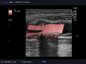 Ultrazvok vratnih žil - kalciniran plak v bulbusu in notranji karotidi