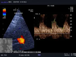 anevrizma sprednje komunikantne arterije 2