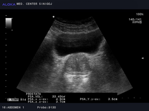 Ultrazvok prostate - benigna hipertrofija prostate 4