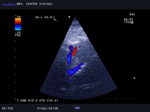 Ultrazvok možganskih žil - bazilarna in vertebralni arteriji  normalen izvid 2