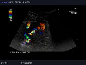 Ultrazvok možganskih žil - bazilarna in vertebralni arteriji, normalen izvid