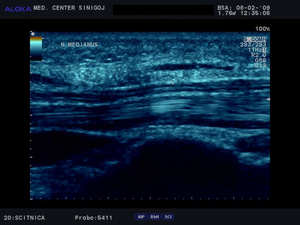Ultrazvok karpalnega kanala - nervus medianus vzdolžno  normalen izvid