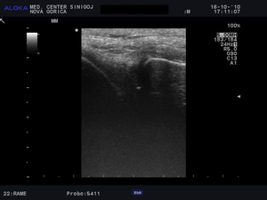 Ultrazvok kolena - možna poškodba meniska