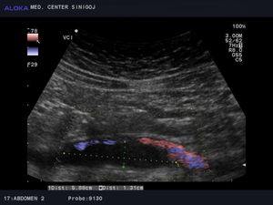 Ultrazvok žil trebuha - tromboza vene cave inferior