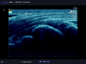 Ultrazvok zapestja - normalen izvid zapestja  v sredini zapestna koščica os lunatum
