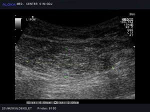 Ultrazvok kože - lipom v podkožju