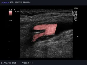 Ultrazvok vratnih žil - aterosklerotični plak v notranji karotidni arteriji