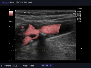 Ultrazvok vratnih žil - zožitev bulbusa in notranje karotidne arterije