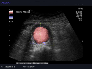 Ultrazvok žil trebuha - anevrizma abdominalne aorte  prečno