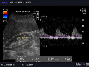 Ultrazvok ledvic - kronična parenhimska okvara ledvice  povišan RI