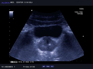 Ultrazvok prostate - benigna hipertrofija prostate 11