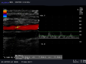 Ultrazvok žil nog - znižane hitrosti v golenični arteriji (a. tibialis posterior).jpg