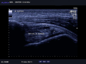 Ultrazvok rame - tendinoza tetive supraspinatusa z natrganjem