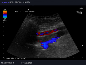 Ultrazvok žil trebuha - tromboza iliakalnih ven