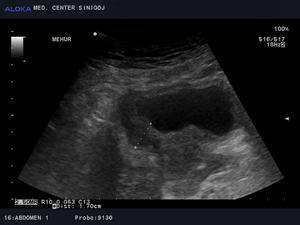 Ultrazvok mehurja - tumor mehurja  infiltrira v področje prostate 2