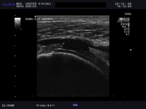 Ultrazvok rame - utrgana tetiva supraspinatusa